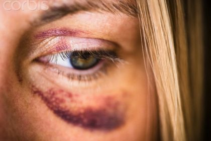 USA, New Jersey, Jersey City, Portrait of woman with black eye