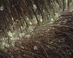 Odor-no-couro-cabeludo–300×236