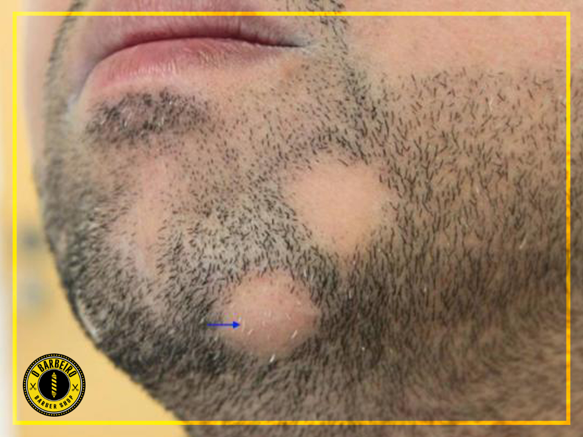 alopécia barba 1