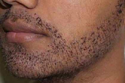implante-barba-mv1bjqm8b16kg1fe7boeknyb9ic9gjjpccqabwov7k